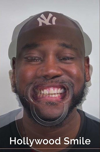 Hollywood Smile Transformation in Istanbul