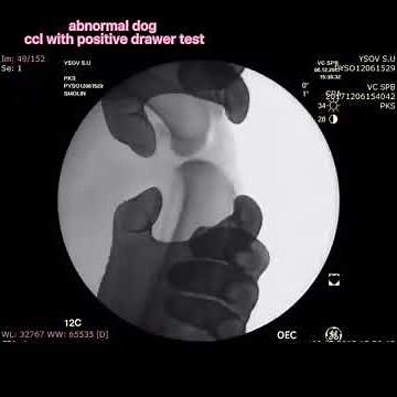 What is a drawer test or Tibial Thrust?