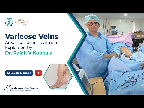 Varicose Veins Advance Laser Treatment Explained by Dr Rajah V Koppala | Avis Hospitals