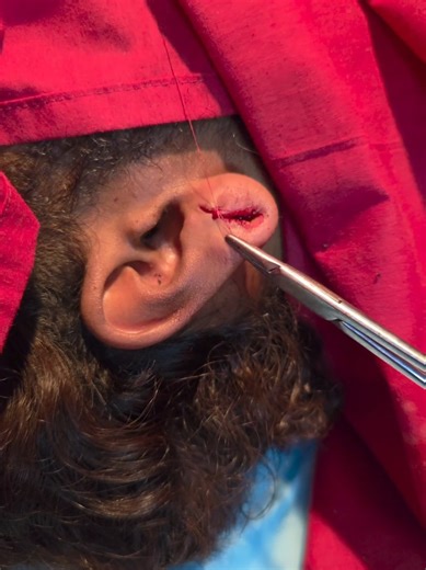 Sambung Semula Lubang Cuping yang Besar