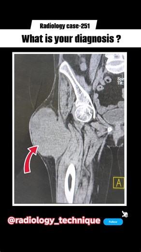 110K views · 424 reactions | Radiology case-251 A 60 years old female presents with semisolid cystic swelling Rt side of thigh region.. What is your diagnosis..? #radiology_technique #rellsfacebook #mbbsabroad #radiographer #radiology #radiologylife #fb #xray #gastrology #radiography #mbbs #mbbsstudent #radiologia #medicos #medicolife | Diwakar Patel | Facebook