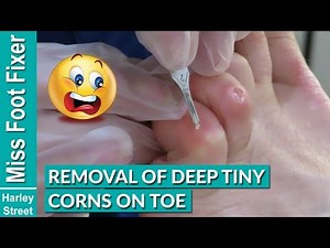 Removal of Deep Tiny Corns on Toes Miss Foot Fixer Marion Yau