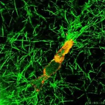 Fibroblast moving through collagen net; thereby causing fascial contracture