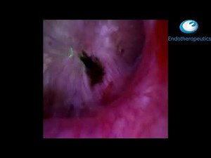 Innovex - Laser Lithotripsy Surgical Video