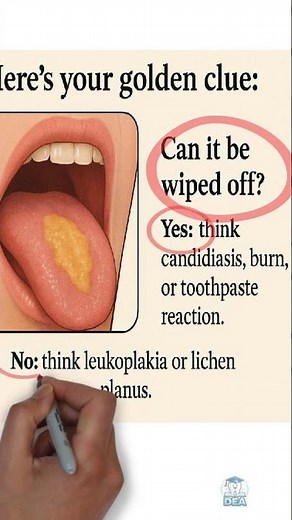 White Patch on Tongue Don’t Ignore This!