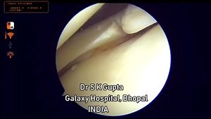 Arthroscopic Lateral Meniscus Radial Tear Repair Using Knee Scorpion