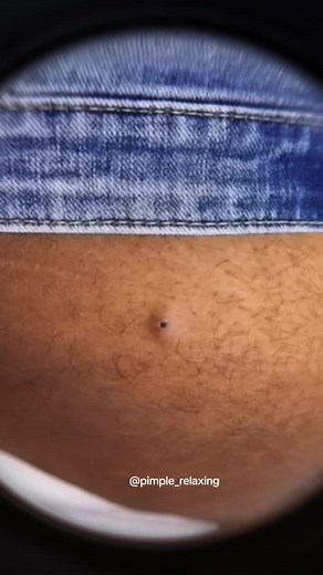 Best video you will watch today 🥰 #supersatisfying #pimplepop #blackheads #extractionsatisfaciton