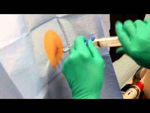 Bone marrow extraction