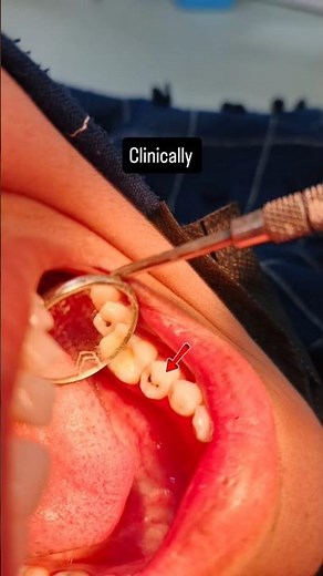 Class 1 composite restoration #dentalshorts