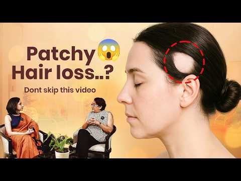 Patchy Hair Loss? Here's What You Need to Know