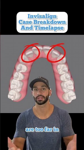 Invisalign Case Breakdown And Timelapse For A Young Professional. 2023