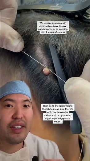 Removing moles at the barber with string? #shorts