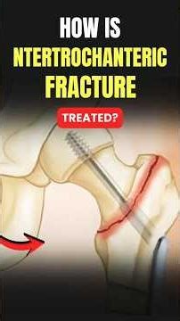 How is Intertrochanteric Fracture treated? | #hipfracture treatment in hindi | Dr. Amite Pankaj