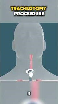 Tracheotomy Procedure Explained in 60 Second 3D animation