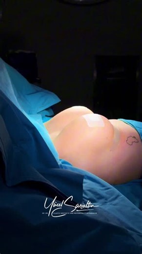 500cc Breast Augmentation by Dr. Yücel Sar?alt?n