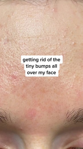 Dealing with Tiny Bumps on Face: Skin Transformation Journey