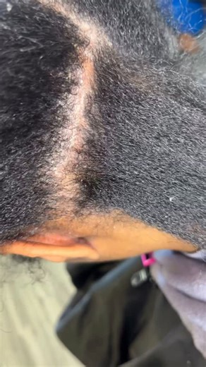 Pro Stylist - Las Vegas👸🏾 on Instagram: "Seborrheic Dermatitis or Psoriasis?"