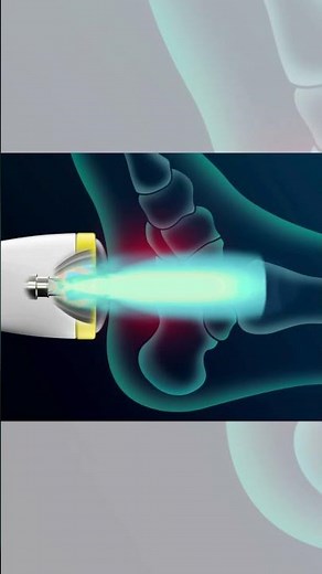 SoftWave Focal Zone (Simulation)