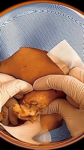 Extreme Giant Cyst Removal 🤮