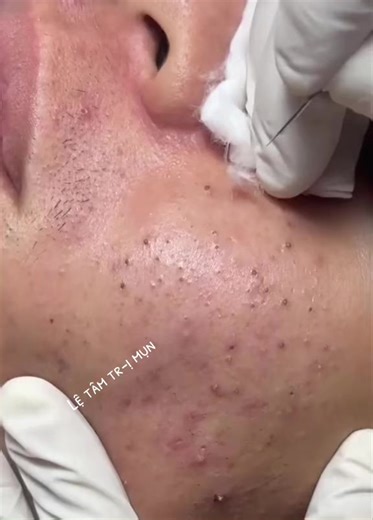 Pore Extraction Process: Close-Up Skin Treatment
