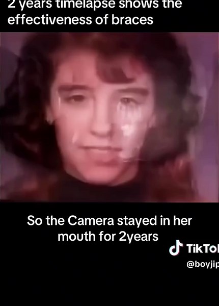 Two-Year Braces Transformation Timelapse