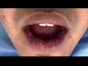 Lip Reduction Surgery