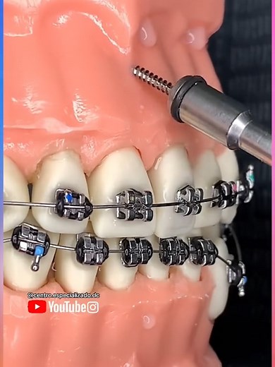 The Scariest Dentist Device Revealed! See What It Can Do!