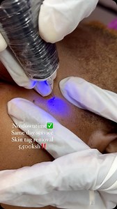11 reactions | Do not try to remove a skin tag yourself , Risks...