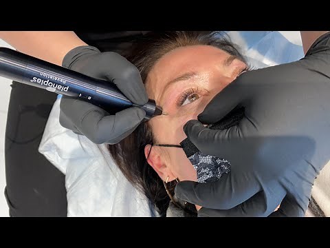 NON SURGICAL EYE LIFT WITH PLASMA PEN | Dr. Jason Emer | West Hollywood, CA