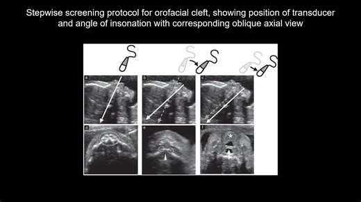 New #UOGJournal videoclip presents a novel approach to distinguishing submucous cleft palate from isolated cleft palate by ultrasound visualization of fetal swallowing. The report is available #freeaccess for a limited time only: https://bit.ly/3trJPmy #ISUOG #LoveUltrasound | International Society of Ultrasound in Obstetrics and Gynecology (ISUOG)