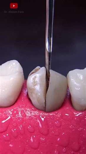 #tooth #dentist #dentistry #dentalcare #dentalprocedure | Bruce Shapiro | 18 comments