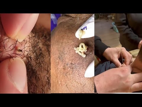 Popping huge blackheads and Pimple Popping - Best Pimple Popping Videos 269