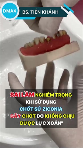 Hướng Dẫn Sử Dụng Chốt Sợi Thủy Tinh Hiệu Quả