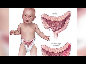 Doctors Remove 30 Pounds Of Poop From Man’s Colon