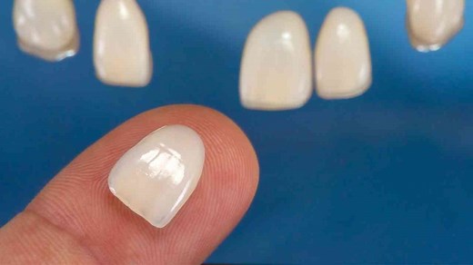 Top 7 Dental Veneer Brands