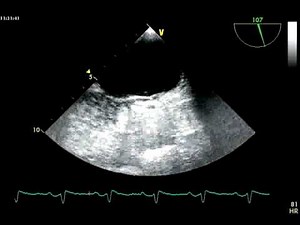 BUBBLE STUDY POSITIVE / SHUNT / PFO TUNNEL