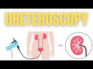 URETEROSCOPY PROCEDURE