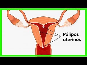 Symptome von Gebärmutterpolypen