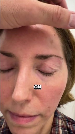 Upper Blepharoplasty with scar revision: 7-Day Post-Op Update
