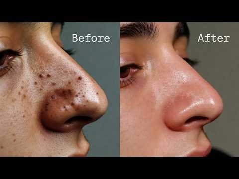 Before & After Blackhead Extraction | Deep Pore Detox Facial Results