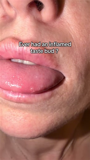 Seriously, anyone else do this? And yes I know I need a dermaplane and some pore cleansing 😏 #skin #tastebud #ouch