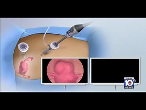 Minimally invasive approach treats fibroids