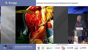 Proximal Humeral Replacement: Overview & Technique