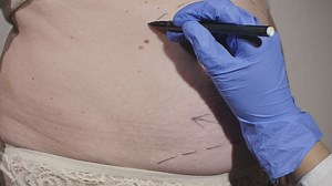 Marking a woman's abdomen before liposuction - Free Stock Video