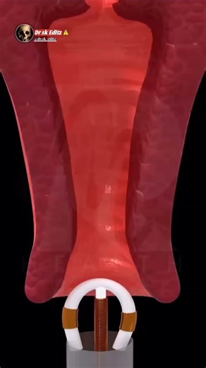 Doctor sk 👩🏻‍⚕️ on Instagram: "💡How does an IUD work? An IUD is a small device inserted into the uterus. It prevents sperm from reaching the egg and changes the uterine environment to reduce the chances of fertilization. In simple terms, it protects you from pregnancy in an effective and long-term way. #Contraception #IUD Copper B #Women'sHealth #familyplanning midnurse#"