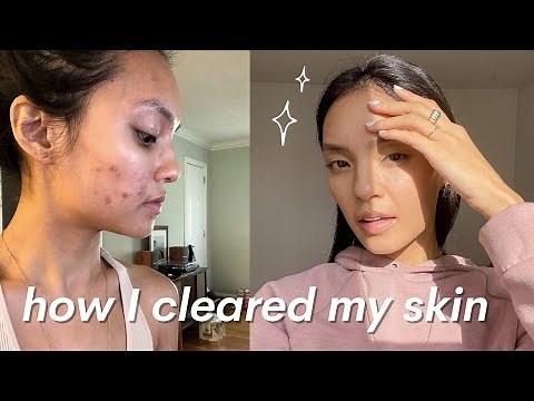 how I cleared my skin naturally | hormonal acne for dry & sensitive skin