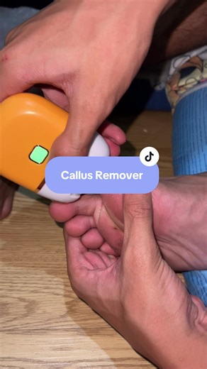 Wireless Electric Foot File Review: Effective Callus Remover