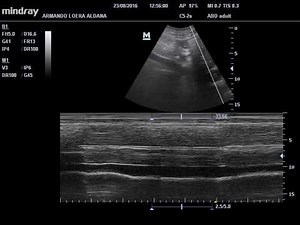 VENA CAVA INFERIOR: COLAPSABILIDAD