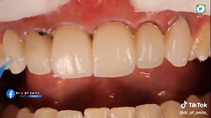 Dental Crown Cementation Process Explained Step by Step