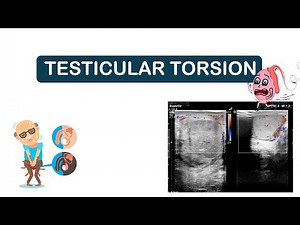 TESTICULAR TORSION | CAUSES OF TESTICULAR TORSION , SYMPTOMS ,DIAGNOSIS, TREATMENT